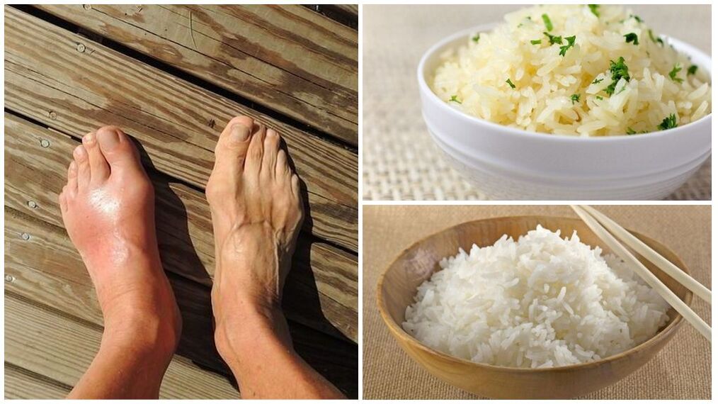 Se recomienda una dieta a base de arroz para pacientes con gota. 